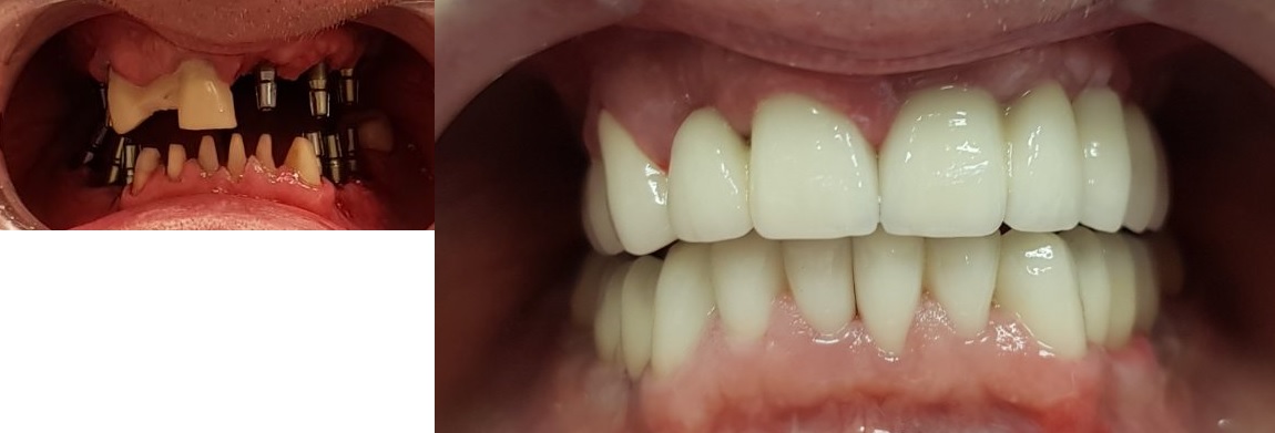 dental implants hungary before after