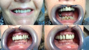 Pre-treatment dental condition with missing teeth, showcasing the need for All on 6 dental implants.