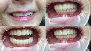 This photo depicts the patient’s oral health before undergoing the All on 6 treatment. It clearly shows the areas of concern, including missing teeth and potential bone loss, demonstrating the need for a full-mouth restoration solution.