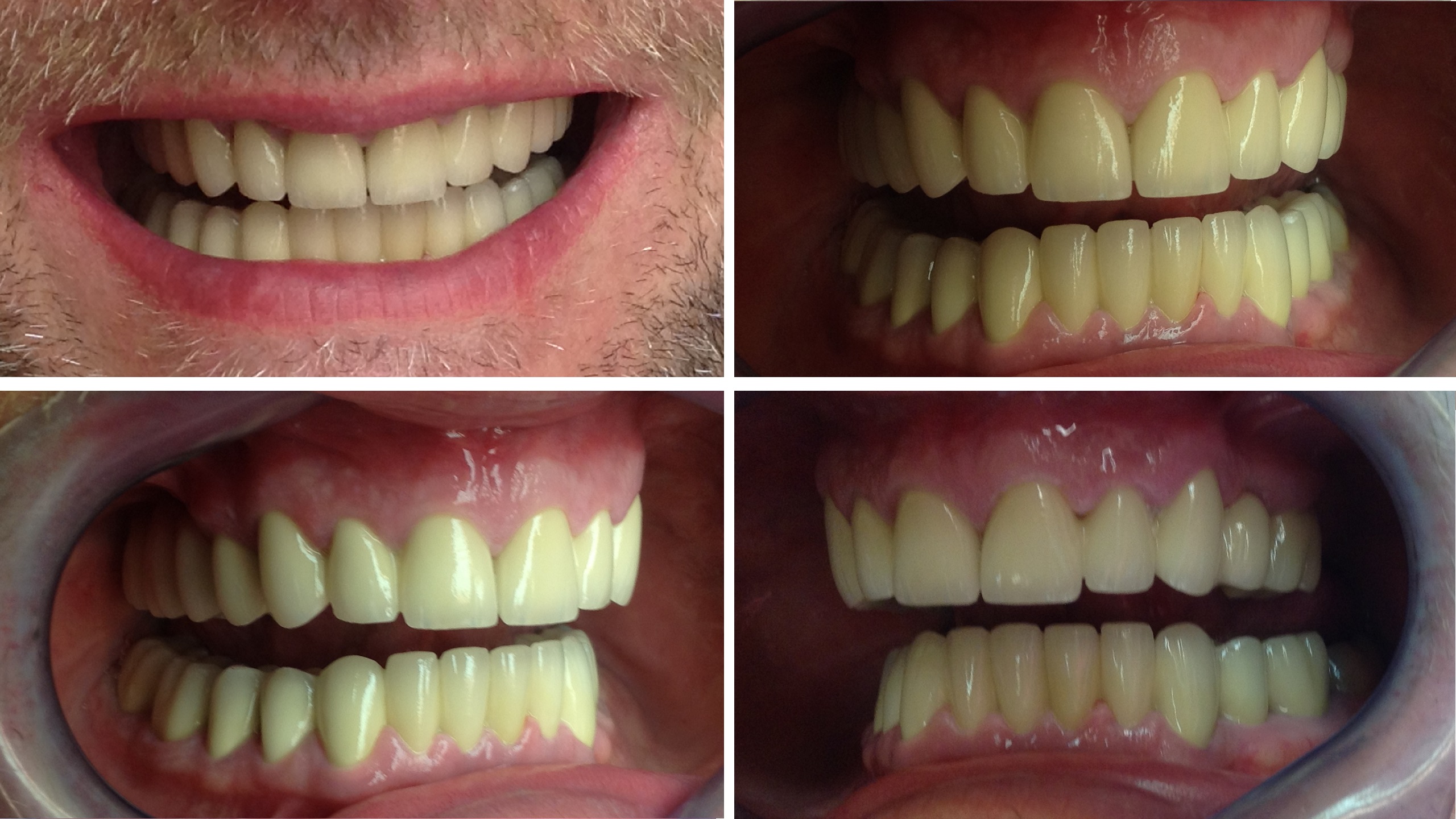 After treatment composite photo displaying a natural smile with 24 zirconium crowns and dental implants, completed at our Budapest clinic.